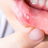 Aften in de mond: complete gids over oorzaken, symptomen, behandeling en pijnlijke aften