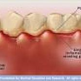 Gingivitis