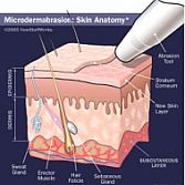 Microdermabrasie